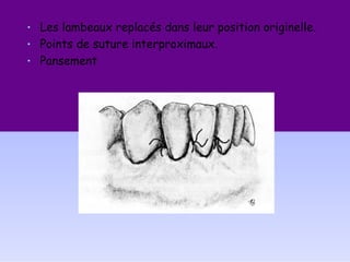 • Les lambeaux replacés dans leur position originelle.
• Points de suture interproximaux.
• Pansement
 