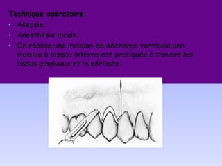 Technique opératoire:
• Asepsie.
• Anesthésie locale.
• On réalise une incision de décharge verticale,une
incision à biseau interne est pratiquée à travers les
tissus gingivaux et le périoste.
 