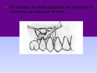 • Un lambeau de pleine épaisseur est récliné et la
collerette de tissus est éliminé.
 