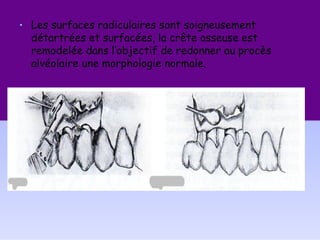 • Les surfaces radiculaires sont soigneusement
détartrées et surfacées, la crête osseuse est
remodelée dans l’objectif de redonner au procès
alvéolaire une morphologie normale.
 