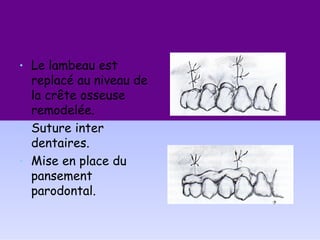 • Le lambeau est
replacé au niveau de
la crête osseuse
remodelée.
• Suture inter
dentaires.
• Mise en place du
pansement
parodontal.
 