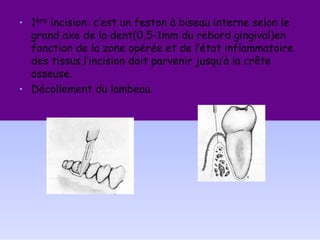 • 1ère incision: c’est un feston à biseau interne selon le
grand axe de la dent(0,5-1mm du rebord gingival)en
fonction de la zone opérée et de l’état inflammatoire
des tissus,l’incision doit parvenir jusqu’à la crête
osseuse.
• Décollement du lambeau.
 