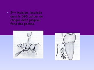 • 2ème incision: localisée
dans le SGD autour de
chaque dent jusqu’au
fond des poches.
 