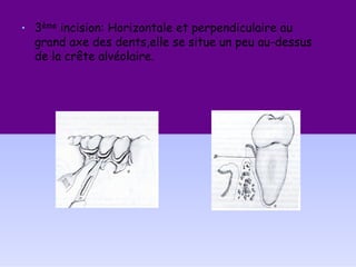• 3ème incision: Horizontale et perpendiculaire au
grand axe des dents,elle se situe un peu au-dessus
de la crête alvéolaire.
 
