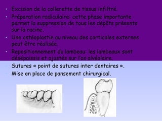 • Excision de la collerette de tissus infiltré.
• Préparation radiculaire: cette phase importante
permet la suppression de tous les dépôts présents
sur la racine.
• Une ostéoplastie au niveau des corticales externes
peut être réalisée.
• Repositionnement du lambeau: les lambeaux sont
désépaissis et ajustés sur l’os alvéolaire.
• Sutures « point de sutures inter dentaires ».
• Mise en place de pansement chirurgical.
 