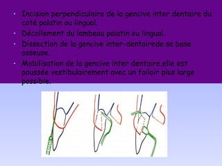 • Incision perpendiculaire de la gencive inter dentaire du
coté palatin ou lingual.
• Décollement du lambeau palatin ou lingual.
• Dissection de la gencive inter-dentairede sa base
osseuse.
• Mobilisation de la gencive inter dentaire,elle est
poussée vestibulairement avec un foiloir plus large
possible.
 