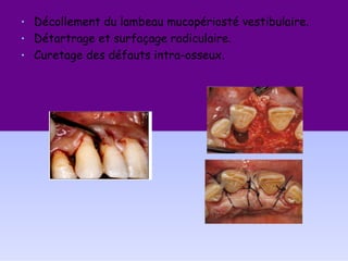 • Décollement du lambeau mucopériosté vestibulaire.
• Détartrage et surfaçage radiculaire.
• Curetage des défauts intra-osseux.
 