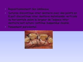 • Repositionnement des lambeaux.
• Sutures discontinue inter dentaire avec des points en
8;soit discontinue inter dentaire matelassée verticale
ou horizontale selon la largeur de l’espace inter
dentaire;soit suture continue suspendue double.
• Pansement parodontal.
 