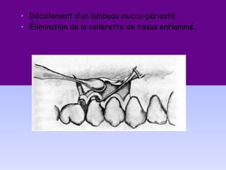 • Décollement d’un lambeau mucco-périosté.
• Élimination de la collerette de tissus enflammé.
 