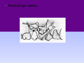 • Remodelage osseux.
 