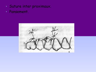 • Suture inter proximaux.
• Pansement.
 