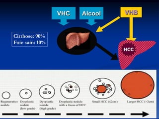 VHC   Alcool   VHB


Cirrhose: 90%
Foie sain: 10%
                                HCC




                                      10
 