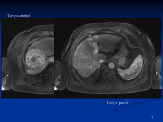 Temps artériel




                 Temps portal


                                15
 