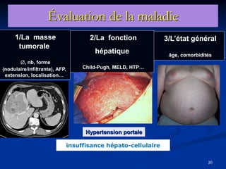 Évaluation de la maladie
     1/La masse                        2/La fonction             3/L’état général
      tumorale
                                         hépatique                âge, comorbidités
       , nb, forme
(nodulaire/infiltrante), AFP,        Child-Pugh, MELD, HTP…
 extension, localisation…




                                                         Approche
                                                       hépatologique
                                      Hypertension portale

                                insuffisance hépato-cellulaire

                                                                                 20
 