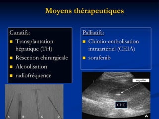 Moyens thérapeutiques

Curatifs:                  Palliatifs:
 Transplantation           Chimio-embolisation
  hépatique (TH)             intraartériel (CEIA)
 Résection chirurgicale    sorafenib

 Alcoolisation

 radiofréquence




                                        CHC

                                                    24
 