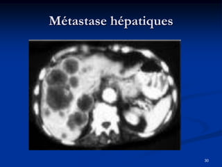 Métastase hépatiques




                       30
 