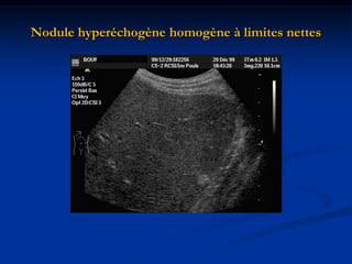 Nodule hyperéchogène homogène à limites nettes
 