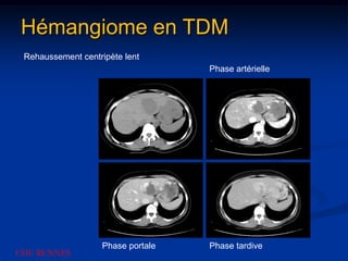 Hémangiome en TDM
 Rehaussement centripète lent
                                   Phase artérielle




                   Phase portale   Phase tardive
CHU RENNES
 