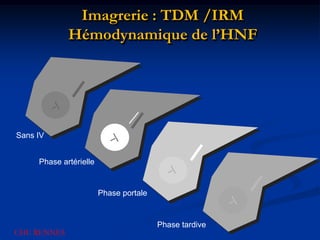 Imagrerie : TDM /IRM
             Hémodynamique de l’HNF




Sans IV


     Phase artérielle


                        Phase portale


                                        Phase tardive
CHU RENNES
 