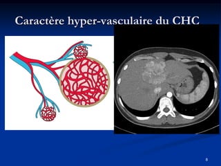 Caractère hyper-vasculaire du CHC




                                    8
 
