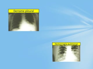 Derrame pleural
Hemorragia pulmonar
 