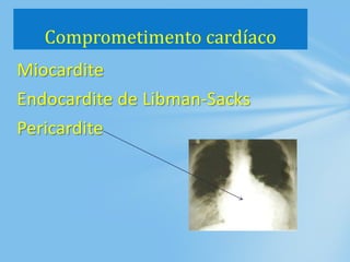 Miocardite
Endocardite de Libman-Sacks
Pericardite
Comprometimento cardíaco
 