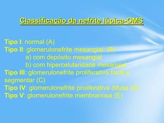 Classificação da nefrite lúpica-OMS
Tipo I: normal (A)
Tipo II: glomerulonefrite mesangial: (B)
a) com depósito mesangial
b) com hipercelularidade mesangial
Tipo III: glomerulonefrite proliferativa focal e
segmentar (C)
Tipo IV: glomerulonefrite proliferativa difusa (D)
Tipo V: glomerulonefrite membranosa (E)
 