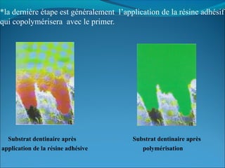 *la dernière étape est généralement l’application de la résine adhésif
qui copolymérisera avec le primer.
Substrat dentinaire après Substrat dentinaire après
application de la résine adhésive polymérisation
 