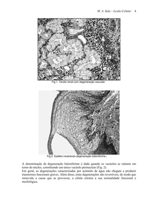 M. A. Sala – Lesão Celular   4




                       Fig.1. Tecido renal com degeneração vacuolar




                   Fig.2. Epitélio mostrando degeneração baloniforme.

A denominação de degeneração baloniforme é dada quando os vacúolos se reúnem em
torno do núcleo, constituindo um único vacúolo perinuclear (Fig. 2).
Em geral, as degenerações caracterizadas por acúmulo de água não chegam a produzir
transtornos funcionais graves. Além disso, estas degenerações são reversíveis, de modo que
removida a causa que as provocou, a célula retorna a sua normalidade funcional e
morfológica.
 