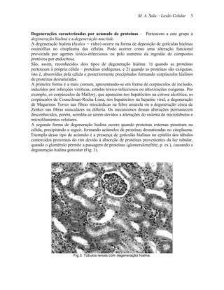 M. A. Sala – Lesão Celular   5



Degenerações caracterizadas por acúmulo de proteínas – Pertencem a este grupo a
degeneração hialina e a degeneração mucóide.
A degeneração hialina (hyalos = vidro) ocorre na forma de deposição de gotículas hialinas
eosinófilas no citoplasma das células. Pode ocorrer como uma alteração funcional
provocada por agentes tóxico-infecciosos ou pelo aumento da ingestão de compostos
protéicos por endocitose.
São, assim, reconhecidos dois tipos de degeneração hialina: 1) quando as proteínas
pertencem à própria célula – proteínas endógenas, e 2) quando as proteínas são exógenas,
isto é, absorvidas pela célula e posteriormente precipitadas formando corpúsculos hialinos
de proteínas desnaturadas.
A primeira forma é a mais comum, apresentando-se em forma de corpúsculos de inclusão,
induzidos por infecções viróticas, estados tóxico-infecciosos ou intoxicações exógenas. Por
exemplo, os corpúsculos de Mallory, que aparecem nos hepatócitos na cirrose alcoólica; os
corpúsculos de Councilman-Rocha Lima, nos hepatócitos na hepatite viral; a degeneração
de Magarinos Torres nas fibras miocárdicas na febre amarela ou a degeneração cérea de
Zenker nas fibras musculares na difteria. Os mecanismos dessas alterações permanecem
desconhecidos, porém, acredita-se serem devidos a alterações do sistema de microtúbulos e
microfilamentos celulares.
A segunda forma de degeneração hialina ocorre quando proteínas externas penetram na
célula, precipitando a seguir, formando acúmulos de proteínas desnaturadas no citoplasma.
Exemplo desse tipo de acúmulo é a presença de gotículas hialinas no epitélio dos túbulos
contorcidos proximais do rim devido à absorção de proteínas provenientes da luz tubular,
quando o glomérulo permite a passagem de proteínas (glomerulonefrite, p. ex.), causando a
degeneração hialina goticular (Fig. 3).




                       Fig.3. Túbulos renais com degeneração hialina.
 