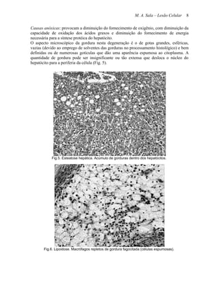 M. A. Sala – Lesão Celular   8

Causas anóxicas: provocam a diminuição do fornecimento de oxigênio, com diminuição da
capacidade de oxidação dos ácidos graxos e diminuição do fornecimento de energia
necessária para a síntese protéica do hepatócito.
O aspecto microscópico da gordura nesta degeneração é o de gotas grandes, esféricas,
vazias (devido ao emprego de solventes das gorduras no processamento histológico) e bem
definidas ou de numerosas gotículas que dão uma aparência espumosa ao citoplasma. A
quantidade de gordura pode ser insignificante ou tão extensa que desloca o núcleo do
hepatócito para a periferia da célula (Fig. 5).




           Fig.5. Esteatose hepática. Acúmulo de gorduras dentro dos hepatócitos.




       Fig.6. Lipoidose. Macrófagos repletos de gordura fagocitada (células espumosas).
 