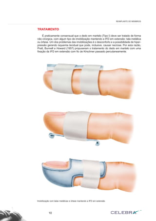 TRATAMENTO
É praticamente consensual que o dedo em martelo (Tipo I) deve ser tratado de forma
não cirúrgica, com algum tipo de imobilização mantendo a IFD em extensão: tala metálica
ou órtese. Um dos problemas das imobilizações é o desconforto e a possibilidade de hiper-
pressão gerando isquemia tecidual que pode, inclusive, causar necrose. Por esta razão,
Pratt, Bunnell e Howard (1957) propuseram o tratamento do dedo em martelo com uma
fixação da IFD em extensão com fio de Kirschner passado percutaneamente.
10
REIMPLANTE DE MEMBROS
Imobilização com talas metálicas e órtese mantendo a IFD em extensão.
 