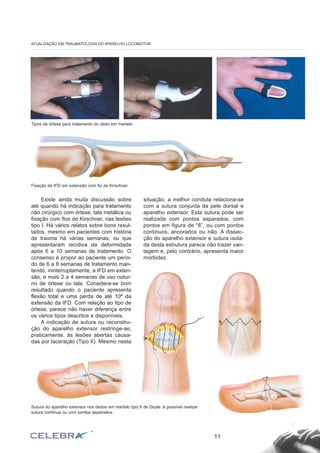 Existe ainda muita discussão sobre
até quando há indicação para tratamento
não cirúrgico com órtese, tala metálica ou
fixação com fios de Kirschner, nas lesões
tipo I. Há vários relatos sobre bons resul-
tados, mesmo em pacientes com história
de trauma há várias semanas, ou que
apresentaram recidiva da deformidade
após 6 a 10 semanas de tratamento. O
consenso é propor ao paciente um perío-
do de 6 a 8 semanas de tratamento man-
tendo, ininterruptamente, a IFD em exten-
são, e mais 2 a 4 semanas de uso notur-
no de órtese ou tala. Considera-se bom
resultado quando o paciente apresenta
flexão total e uma perda de até 10º da
extensão da IFD. Com relação ao tipo de
órtese, parece não haver diferença entre
os vários tipos descritos e disponíveis.
A indicação de sutura ou reconstru-
ção do aparelho extensor restringe-se,
praticamente, às lesões abertas causa-
das por laceração (Tipo II). Mesmo nesta
situação, a melhor conduta relaciona-se
com a sutura conjunta da pele dorsal e
aparelho extensor. Esta sutura pode ser
realizada com pontos separados, com
pontos em figura de “8”, ou com pontos
contínuos, ancorados ou não. A dissec-
ção do aparelho extensor e sutura isola-
da desta estrutura parece não trazer van-
tagem e, pelo contrário, apresenta maior
morbidez.
11
ATUALIZAÇÃO EM TRAUMATOLOGIA DO APARELHO LOCOMOTOR
Fixação da IFD em extensão com fio de Kirschner.
Tipos de órtese para tratamento do dedo em martelo
Sutura do aparelho extensor nos dedos em martelo tipo II de Doyle: é possível realizar
sutura contínua ou com pontos separados.
 