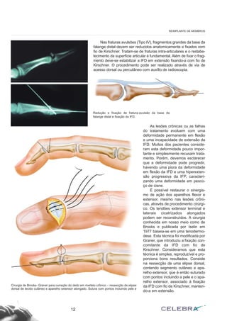 Nas fraturas avulsões (Tipo IV), fragmentos grandes da base da
falange distal devem ser reduzidos anatomicamente e fixados com
fio de Kirschner. Tratam-se de fraturas intra-articulares e o restabe-
lecimento da superfície articular é fundamental. Além de fixar o frag-
mento deve-se estabilizar a IFD em extensão fixando-a com fio de
Kirschner. O procedimento pode ser realizado através de via de
acesso dorsal ou percutâneo com auxílio de radioscopia.
12
REIMPLANTE DE MEMBROS
Redução e fixação de fratura-avulsão da base da
falange distal e fixação da IFD.
As lesões crônicas ou as falhas
do tratamento evoluem com uma
deformidade permanente em flexão
e uma incapacidade de extensão da
IFD. Muitos dos pacientes conside-
ram esta deformidade pouco impor-
tante e simplesmente recusam trata-
mento. Porém, devemos esclarecer
que a deformidade pode progredir,
havendo uma piora da deformidade
em flexão da IFD e uma hiperexten-
são progressiva da IFP, caracteri-
zando uma deformidade em pesco-
ço de cisne.
É possível restaurar o sinergis-
mo de ação dos aparelhos flexor e
extensor, mesmo nas lesões crôni-
cas, através de procedimento cirúrgi-
co. Os tendões extensor terminal e
laterais cicatrizados alongados
podem ser reconstruídos. A cirurgia
conhecida em nosso meio como de
Brooks e publicada por Iselin em
1977 baseia-se em uma tenodermo-
dese. Esta técnica foi modificada por
Graner, que introduziu a fixação con-
comitante da IFD com fio de
Kirschner. Consideramos que esta
técnica é simples, reproduzível e pro-
porciona bons resultados. Consiste
na ressecção de uma elipse dorsal,
contendo segmento cutâneo e apa-
relho extensor, que é então suturado
com pontos incluindo a pele e o apa-
relho extensor, associado à fixação
da IFD com fio de Kirschner, manten-
do-a em extensão.
Cirurgia de Brooks- Graner para correção do dedo em martelo crônico – ressecção de elipse
dorsal de tecido cutâneo e aparelho extensor alongado. Sutura com pontos incluindo pele e
 