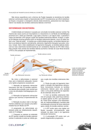 Não temos experiência com a técnica de Fowler baseada na tenotomia do tendão
extensor central para impedir a hiperextensão da IFP. Consideramos ser difícil redistribuir
as forças e recuperar o sinergismo através desta tenotomia, parecendo-nos mais lógico
intervir nos lesões dos tendões extensores laterais e terminal.
DEFORMIDADE EM BOTOEIRA
A deformidade em botoeira é causada por uma lesão do tendão extensor central. Na
maioria das vezes ocorre por traumatismo e o mecanismo é o de flexão da interfalângica
proximal com o dedo em extensão. Logo após o trauma e, por alguns dias, o paciente é
capaz de estender a IFP graças a ação dos tendões extensores laterais. A seguir, a cabe-
ça da falange proximal penetra entre os tendões extensores laterais, como se estes fos-
sem uma “casa de botão” . A medida que a deformidade progride, os tendões laterais ten-
dem a se deslocar lateral e ventralmente, estirando o ligamento triangular que pode, inclu-
sive, romper. Sem o fator estabilizador do ligamento triangular, os tendões laterais deslo-
cam-se mais volarmente transformando-se em verdadeiros flexores da IFP. Além disso,
esta posição mais ventral dos tendões laterais aumenta a tensão de suas fibras levando
a IFD a uma posição de hiperextensão.
No início a deformidade é redutível
mas, sem o tratamento adequado, haverá
uma rigidez progressiva causada por:
1. Retração do ligamento retinacular
transverso que traz os tendões extenso-
res laterais para posição mais ventral que
o eixo da articulação interfalagangica pro-
ximal.
2. Retração do ligamento retinacular
oblíquo que acentua a hiperextensão da
IFD.
3. Retração da placa volar e dos liga-
mentos colaterais que causam uma defor-
midade fixa em flexão da IFP.
A progressão da deformidade em
botoeira pode ser didaticamente classifi-
cada em 5 estágios:
1. Fraqueza ou paresia na extensão
da IFP devido a lesão do tendão extensor
central. A extensão é pode ser obtida gra-
ças a ação dos tendões extensores late-
rais.
2. Perda da ação do ligamento trian-
gular e retração dos ligamentos retinacu-
lares transversos levando os tendões
extensores laterais para uma posição
volar e uma perda definitiva da capacida-
de de extensão ativa da IFP.
3. Com os tendões extensores late-
rais em posição volar, toda força extenso-
ra estará agindo na IFD, que hiperexten-
de. Pode haver também uma hiperexten-
são da metacarpofalângica causada pela
centralização proximal da força extensora
após a lesão do tendão extensor central.
4. A IFP evolui para uma rigidez em
flexão causada, principalmente, pela
retração da placa volar e do ligamento
retinacular transverso.
5. A articulação IFP evolui com um
quadro degenerativo progressivo.
13
ATUALIZAÇÃO EM TRAUMATOLOGIA DO APARELHO LOCOMOTOR
Tendão extrínseco
Tendão
intrínseco Lig. Retinacular transverso Lig. Retinacular oblíquo
Tendão extensor central
Tendão extensor lateral
Lesão do tendão extensor
central e deslocamento
ventral dos tendões
extensores laterais com
retração do ligamento
retinacular transverso
 