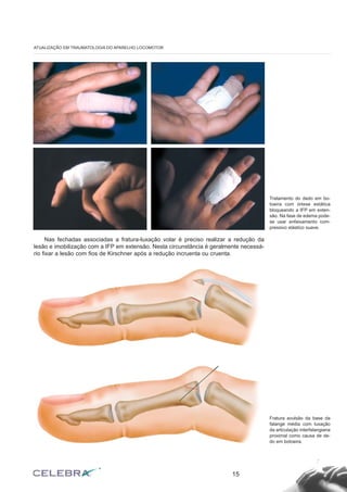 Nas fechadas associadas a fratura-luxação volar é preciso realizar a redução da
lesão e imobilização com a IFP em extensão. Nesta circunstância é geralmente necessá-
rio fixar a lesão com fios de Kirschner após a redução incruenta ou cruenta.
15
ATUALIZAÇÃO EM TRAUMATOLOGIA DO APARELHO LOCOMOTOR
Tratamento do dedo em bo-
toeira com órtese estática
bloqueando a IFP em exten-
são. Na fase de edema pode-
se usar enfaixamento com-
pressivo elástico suave.
Fratura avulsão da base da
falange média com luxação
da articulação interfalangiana
proximal como causa de de-
do em botoeira.
 