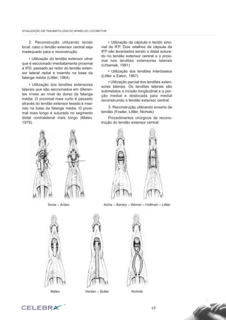 2. Reconstrução utilizando tecido
local: caso o tendão extensor central seja
inadequado para a reconstrução.
• Utilização do tendão extensor ulnar
que é seccionado imediatamente proximal
à IFD, passado ao redor do tendão exten-
sor lateral radial e inserido na base da
falange média (Littler, 1964)
• Utilização dos tendões extensores
laterais que são seccionados em diferen-
tes níveis ao nível do dorso da falange
média. O proximal mais curto é passado
através do tendão extensor lesado e inse-
rido na base da falange média. O proxi-
mal mais longo é suturado no segmento
distal contralateral mais longo (Matev,
1979).
• Utilização da cápsula e tecido sino-
vial da IFP. Dois retalhos da cápsula da
IFP são levantados sendo o distal sutura-
do no tendão extensor central e o proxi-
mal nos tendões extensores laterais
(Urbaniak, 1981)
• Utilização dos tendões interósseos
(Littler e Eaton, 1967)
• Utilização parcial dos tendões exten-
sores laterais. Os tendões laterais são
submetidos a incisão longitudinal e a por-
ção medial e deslocada para medial
reconstruindo o tendão extensor central.
3. Reconstrução utilizando enxerto de
tendão (Fowler, Littler, Nichols)
Procedimentos cirúrgicos de recons-
trução do tendão extensor central:
17
ATUALIZAÇÃO EM TRAUMATOLOGIA DO APARELHO LOCOMOTOR
Snow – Ardeo Aiche – Barsky – Weiner – Hollman – Littler
Matev Verdan – Butler Nichols
 