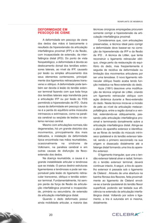 DEFORMIDADE EM
PESCOÇO DE CISNE
A deformidade em pescoço de cisne
dos dedos das mãos é basicamente o
resultado da hiperextensão da articulação
interfalângica proximal (IFP) e da flexão,
com incapacidade de extensão, da inter-
falângica distal (IFD). Do ponto de vista
fisiopatológico, a deformidade é devida ao
deslocamento dorsal dos tendões exten-
sores laterais, ao nível da IFP, causado
por lesão ou simples afrouxamento dos
seus elementos contensores, principal-
mente dos ligamentos retinaculares trans-
verso e oblíquo. A deformidade pode tam-
bém ser devida à lesão do tendão exten-
sor terminal fazendo com que toda força
dos tendões laterais seja transferida para
a articulação IFP ou por lesão do FDS
permitindo a hiperextensão de IFD . Outra
causa da deformidade em pescoço de cis-
ne é a perda do equilíbrio entre músculos
intrínsecos e extrínsecos, como na parali-
sia cerebral ou seqüela de lesões no sis-
tema nervoso central.
Mesmo com articulações normais,não
degeneradas, há um grande distúrbio dos
movimentos, principalmente dos mais
delicados, e instalação da deformidade
típica encontrada nas mãos reumatóides,
ocasionalmente na síndrome de
Volkmann, na paralisia cerebral e em
outras causas de disfunção da flexo-
extensão dos dedos.
Na doença reumatóide, a causa é a
grande instabilidade articular e tendinosa
que se instala. O panus destroi estruturas
ligamentares e tendinosas e pode ser res-
ponsável pela lesão do ligamento retina-
cular transverso, oblíquo e tendão exten-
sor terminal. Fundamentalmente, há sem-
pre perda da força de flexão da articula-
ção interfalângica proximal e incapacida-
de, primária ou secundária, de extensão
da articulação interfalângica distal.
Quando o dedo deformado possui
ainda mobilidade articular, a maioria das
técnicas cirúrgicas empregadas procuram
somente corrigir a hiperextensão da arti-
culação interfalângica proximal.
Consideramos que, com articulações
preservadas, a técnica ideal para corrigir
a deformidade deve basear-se na corre-
ção da hiperextensão da IFP e da flexão
da IFD . A técnica de Littler, que tenta
reconstruir o ligamento retinacular oblí-
quo, chega perto da restauração do equi-
líbrio do dedo, mas freqüentemente é
seguida de recidiva da deformidade ou
limitação dos movimentos articulares por
ser uma tenodese. 0 novo ligamento reti-
nacular oblíquo fixado acaba tendo fun-
ção inelástica na flexo-extensão do dedo.
Azze (1991) descreve uma modifica-
ção da técnica original de Littler, criando
um ligamento retinacular oblíquo com
ação dinâmica durante a flexo-extensão
do dedo. Nesta técnica inicia-se a incisão
de pele ao nível da articulação metacar-
pofalângica, entre a região dorsal e a ven-
tral, estendendo-se obliquamente, pas-
sando pela articulação interfalângica pro-
ximal e terminando dorsalmente sobre a
articulação interfalângica distal. Atinge-se
o plano do aparelho extensor e identifica-
se as fibras do tendão do músculo intrín-
seco ipsilateral e do tendão extensor late-
ral, sendo o primeiro seccionado na sua
origem e dissecado distalmente até a
falange distal formando uma tira do apare-
lho extensor.
O ligamento triangular, que une o ten-
dão extensor lateral ulnar e radial, forman-
do o tendão extensor terminal, deverá
continuar intacto. A seguir, a tira do apare-
lho extensor é passada sob o ligamento
de Cleland . Através de uma abertura na
bainha fibrosa dos flexores, feita proximal-
mente ao ligamento de Cleland envol-
ve-se a banda ipsolateral do tendão flexor
superficial, podendo ser testada sua efi-
ciência na extensão da articulação interfa-
lângica distal. Voltando por sobre o liga-
mento, a tira é suturada em si mesma,
distalmente.
20
REIMPLANTE DE MEMBROS
 