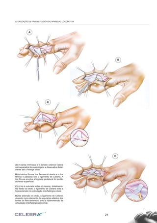 21
ATUALIZAÇÃO EM TRAUMATOLOGIA DO APARELHO LOCOMOTOR
A) A banda intrínseca e o tendão extensor lateral
são separados de suas origens e dissecados distal-
mente até a falange distal.
B) A bainha fibrosa dos flexores é aberta e a tira
fibrosa é passada sob o ligamento de Cleland. A
tira fibrosa envolve a lingüeta ipsolateral do tendão
do flexor superficial.
C) A tira é suturada sobre si mesma, distalmente.
Na flexão do dedo, o ligamento de Cleland evita a
hiperextensão da articulação interfalângica distal.
D) Na extensão do dedo, o ligamento de Cleland,
atuando como elemento de segurança elástico dos
limites da flexo-extensão, evita a hiperextensão da
articulação interfalângica proximal.
A
B
D
C
 