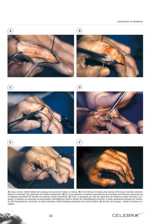 22
REIMPLANTE DE MEMBROS
A) Caso clínico: deformidade em pescoço de cisne em todos os dedos. B) A tira fibrosa formada pela banda intrínseca e tendão extensor
lateral é mostrada. C) Ligamento de Cleland dissecado. D) Por uma abertura na bainha osteofibrosa dos tendões dos flexores apreende-se
a lingüeta ipsolateral do tendão do músculo flexor superficial. E) A tira, é passada por trás do ligamento de Cleland e após envolver a lin-
güeta, é testada na extensão da articulação interfalângica distal e flexão da interfalângica proximal. 0 dedo apresenta posição em botoei-
ra. F) Procedimento concluído no dedo indicador. Deformidades presentes nos outros dedos. G) término da cirurgia – todos os dedos cor-
rigidos
A B
C D
E F
 