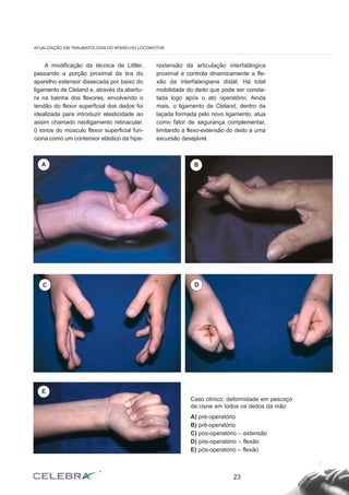 A modificação da técnica de Littler,
passando a porção proximal da tira do
aparelho extensor dissecada por baixo do
ligamento de Cleland e, através da abertu-
ra na bainha dos flexores, envolvendo o
tendão do flexor superficial dos dedos foi
idealizada para introduzir elasticidade ao
assim chamado neoligamento retinacular.
0 tonos do músculo flexor superficial fun-
ciona como um contensor elástico da hipe-
rextensão da articulação interfalângica
proximal e controla dinamicamente a fle-
xão da interfalangiana distal. Há total
mobilidade do dedo que pode ser consta-
tada logo após o ato operatório. Ainda
mais, o ligamento de Cleland, dentro da
laçada formada pelo novo ligamento, atua
como fator de segurança complementar,
limitando a flexo-extensão do dedo a uma
excursão desejável.
23
ATUALIZAÇÃO EM TRAUMATOLOGIA DO APARELHO LOCOMOTOR
Caso clínico: deformidade em pescoço
de cisne em todos os dedos da mão
A) pré-operatório
B) pré-operatório
C) pós-operatório – extensão
D) pós-operatório – flexão
E) pós-operatório – flexão
A B
C D
E
 