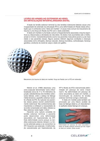 LESÃO DO APARELHO EXTENSOR AO NÍVEL
DA ARTICULAÇÃO INTERFALANGIANA DISTAL
A lesão do tendão extensor terminal ou dos tendões extensores laterais causa uma
incapacidade de extensão da articulação IFD e uma deformidade em flexão desta articu-
lação que é conhecida como “dedo em martelo”. A causa mais comum do mecanismo de
trauma é uma força em flexão da IFD com o dedo extendido.
O dedo em martelo é uma lesão comum e freqüentemente associada a trauma espor-
tivos ou relacionados a atividades da vida diária. Os dedos mais acometidos são o médio,
anular e mínimo. Caracteristicamente ocorre nos pacientes masculinos jovens ou de meia
idade e nas pacientes idosas. Alguns autores referem algumas condições e doenças
associadas como artropatia, doença vascular, doença reumática, corticoterapia, herança
genética, síndrome do túnel do carpo e dedo em gatilho.
8
REIMPLANTE DE MEMBROS
Mecanismo de trauma do dedo em martelo: força em flexão com a IFD em extensão.
Warren et al. (1988) descreveu uma
zona avascular denominada “zona crítica”
localizada cerca de 11 a 16 milímetros da
junção osteotendinosa dos tendões exten-
sores laterais, onde a cabeça da falange
média tensiona o aparelho extensor duran-
te a flexão da IFD. As rupturas nos pacien-
tes idosos parece ocorrer predominante-
mente neste local. Tais conhecimentos são
importantes e enfatizam a necessidade de
se evitar compressão com talas, órteses ou
fitas adesivas nesta região “crítica”.
Havendo uma ruptura completa do
tendão extensor terminal, o paciente
pode desenvolver uma deformidade
secundária em hiperextensão da IFP.
Esta deformidade ocorre porque os ten-
dões extensores laterais retraem e a for-
ca de extensão passa a se concentrar na
IFP, forçando sua extensão. A deformida-
de caracterizada por hiperextensão da
IFP e flexão da IFD é denominada defor-
midade em pescoço de cisne (“swan
neck”). Na deformidade em pescoço de
cisne secundária ao dedo em martelo, a
reconstrução da anatomia do tendão
extensor terminal corrige a disfunção.
O dedo em martelo pode também ser
provocado por uma fratura avulsão da
base da falange distal ou um descolamen-
to epifisário desta falange em crianças.
Deformidade em pescoço de cisne secundária a
lesão do tendão extensor terminal que deu origem
ao dedo em martelo. (Dedo anular)
 