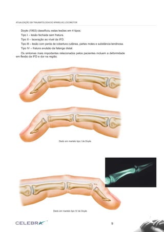 Doyle (1993) classificou estas lesões em 4 tipos:
Tipo I – lesão fechada sem fratura.
Tipo II – laceração ao nível da IFD.
Tipo III – lesão com perda de cobertura cutânea, partes moles e substância tendinosa.
Tipo IV – fratura avulsão da falange distal.
Os sintomas mais importantes relacionados pelos pacientes incluem a deformidade
em flexão da IFD e dor na região.
9
ATUALIZAÇÃO EM TRAUMATOLOGIA DO APARELHO LOCOMOTOR
Dedo em martelo tipo IV de Doyle.
Dedo em martelo tipo I de Doyle.
 