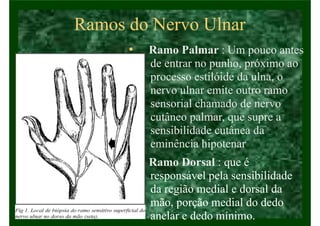 Ramos do Nervo Ulnar
• Ramo Palmar : Um pouco antes
de entrar no punho, próximo ao
processo estilóide da ulna, o
nervo ulnar emite outro ramo
sensorial chamado de nervo
cutâneo palmar, que supre a
sensibilidade cutânea da
eminência hipotenar
• Ramo Dorsal : que é
responsável pela sensibilidade
da região medial e dorsal da
mão, porção medial do dedo
anelar e dedo mínimo.
 