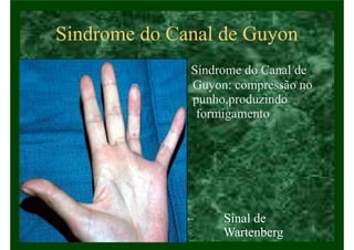 Sindrome do Canal de Guyon
• Síndrome do Canal de
Guyon: compressão no
punho,produzindo
formigamento
– Sinal de
Wartenberg
 
