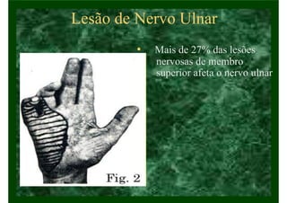 Lesão de Nervo Ulnar
• Mais de 27% das lesões
nervosas de membro
superior afeta o nervo ulnar
 