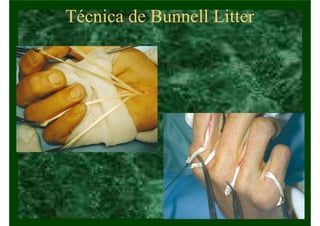 Técnica de Bunnell Litter
 