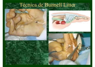 Técnica de Bunnell Litter
 