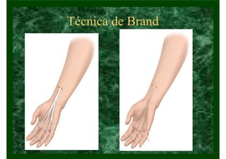 Técnica de Brand
 
