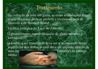 Tratamento
Na correção da mão em garra, se essas articulações forem
muito flexíveis, deve-se preferir a técnica do laço de
Zancolli à de Bunnell-Brand
Técnica cirúrgica do Laço de Zancolli:
O procedimento requer bloqueio do plexo nervoso e
torniquete.
O tendão a ser transferido deve ser o do músculo flexor
superficial dos dedos, o qual deve ser exposto através de
uma incisão oblíqua na face volar (anterior) da falange
média
 